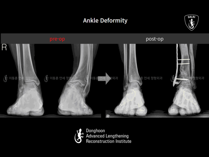 Foot & ankle deformity