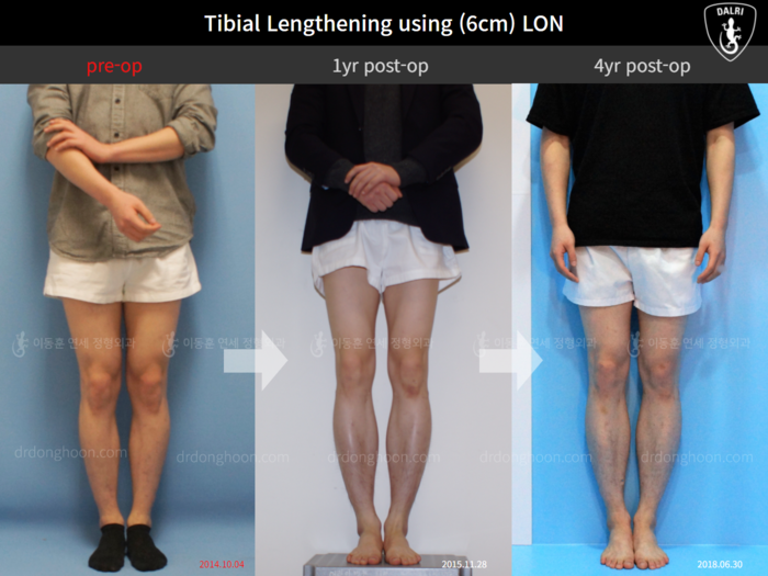 Tibial lengthening, 6 cm gained
