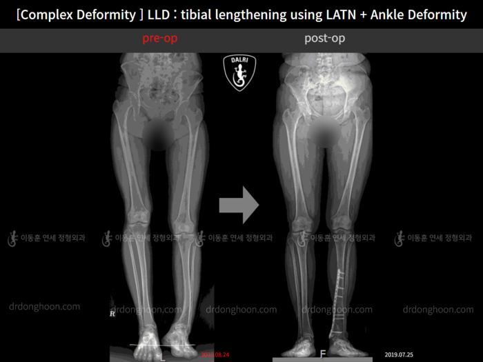 Tibial lengthening