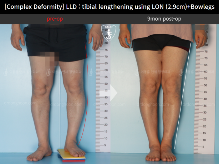 ยืดกระดูกหน้าแข้ง เพิ่มขึ้น 2.9 ซม.