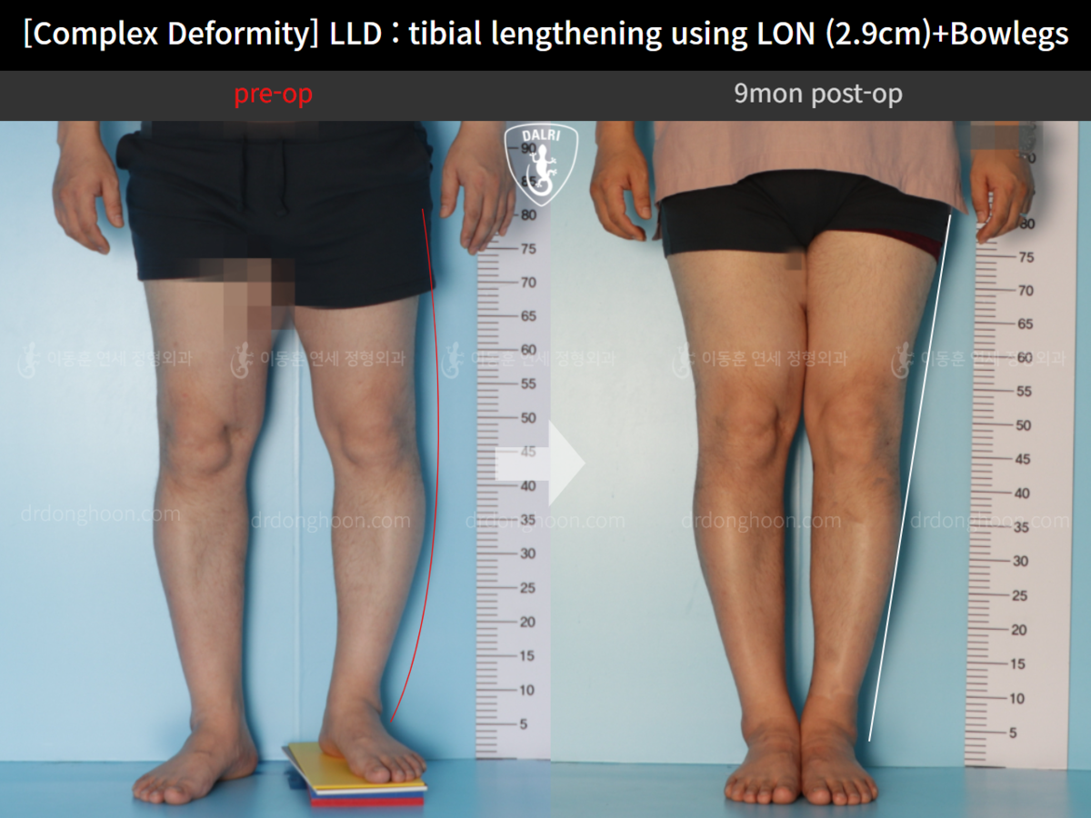 [Complex Deformity] LLD : Tibial Lengthening Using LON (2.9cm)+Bowlegs ...