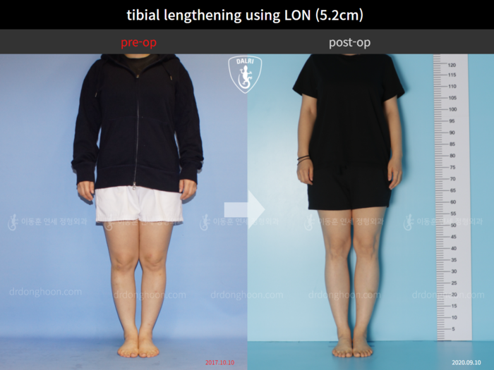 Tibial lengthening, 5.2 cm gained