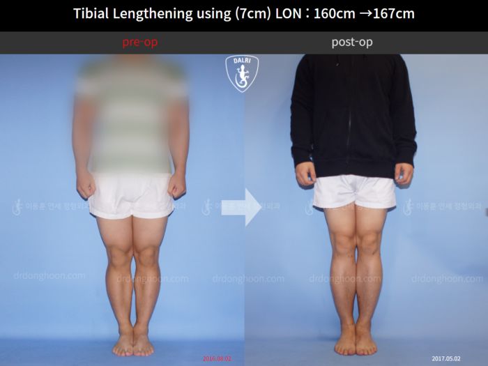 Tibial lengthening, 7 cm gained
