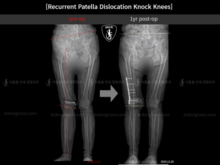 Reoperation after deformity correction