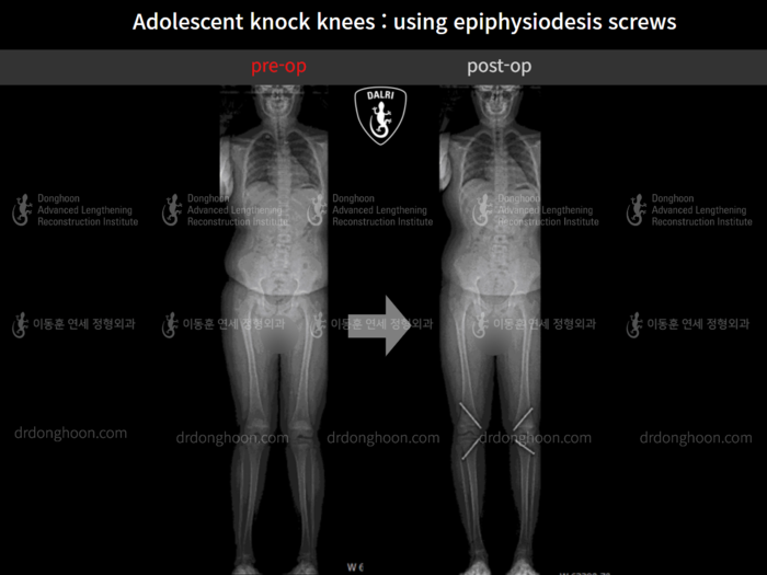 Paediatric & adolescent knock knees
