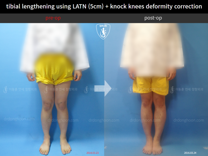 Tibial lengthening, 5 cm gained