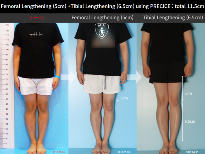 Femoral + tibial lengthening, 5 cm gained