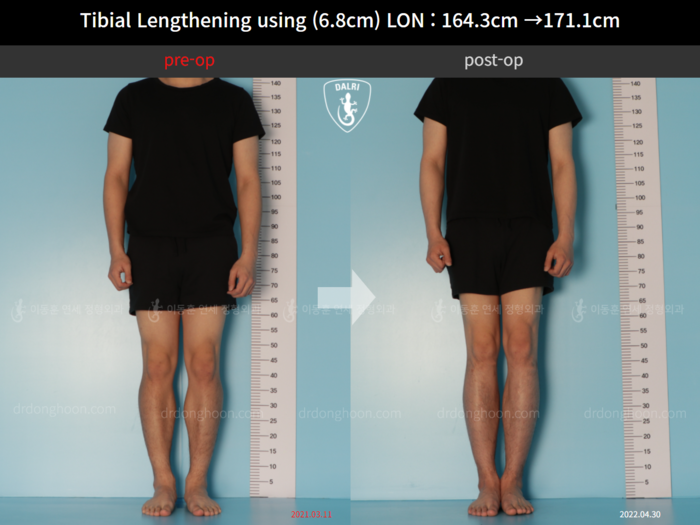 Tibial lengthening, 6.8 cm gained