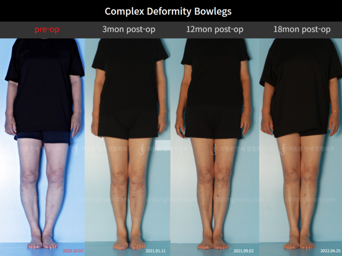 Osteotomy for knee osteoarthritis