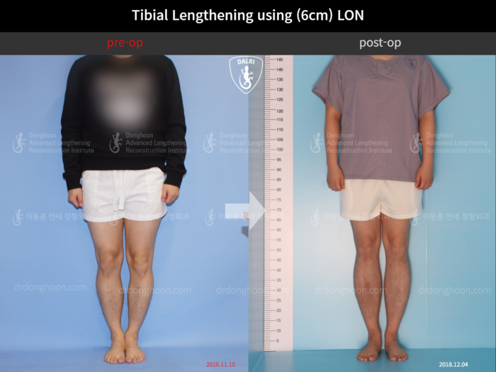 Tibial lengthening, 6 cm gained