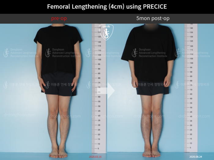 Tibial lengthening, 4 cm gained