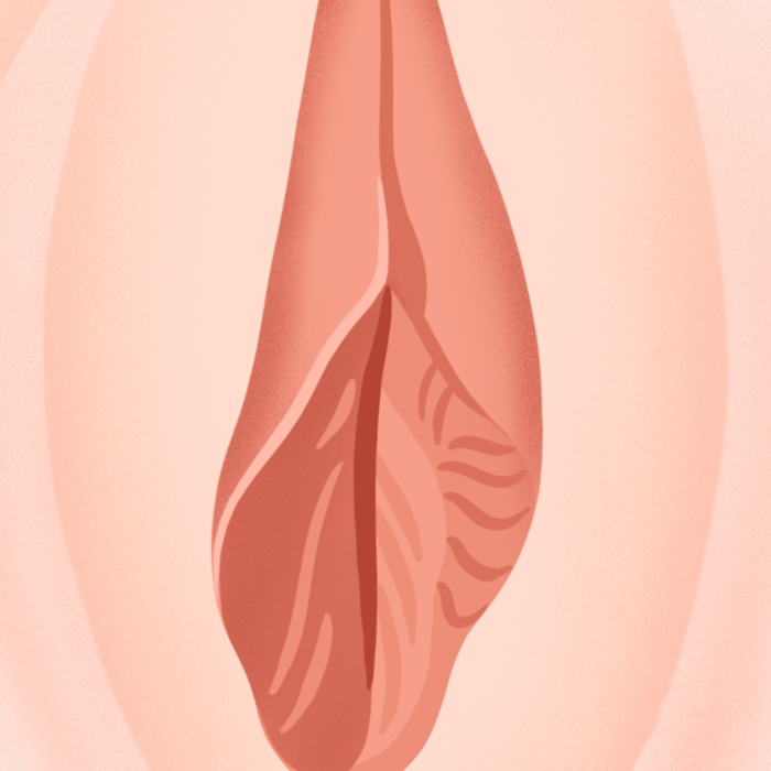 편측 음핵주름 소음순 비대 그림