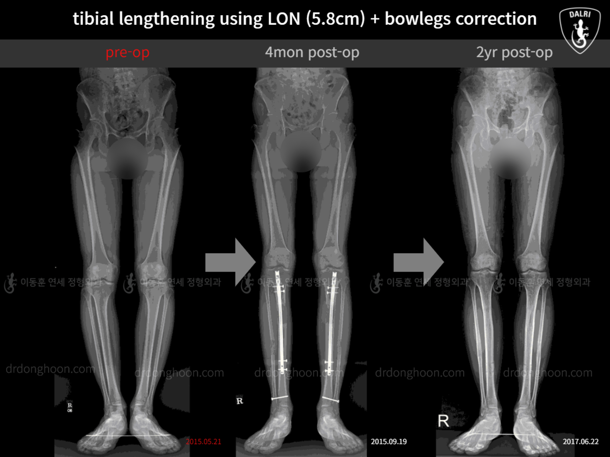 Tibial Lengthening Using LON (5.8cm) + Bowlegs Correction : 2yr Post-op ...