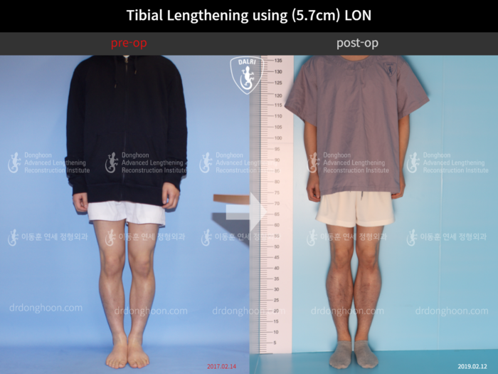 Tibial lengthening, 5.7 cm gained