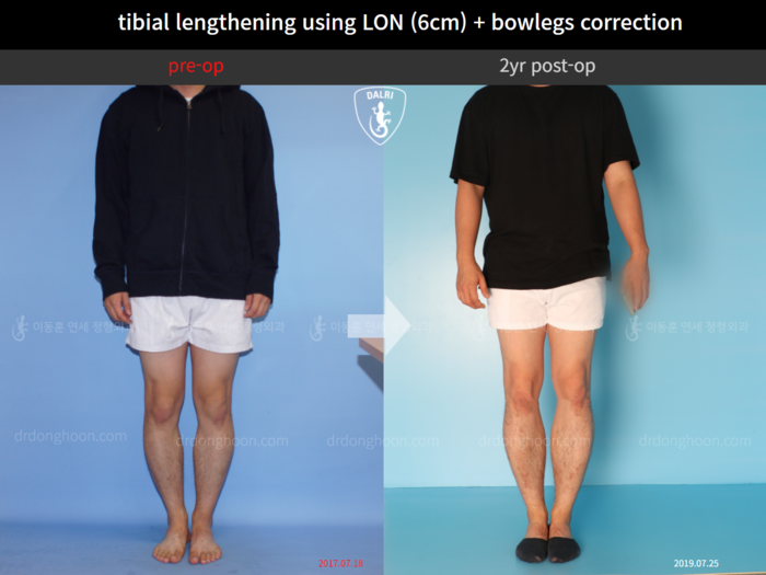 Tibial lengthening, 6 cm gained