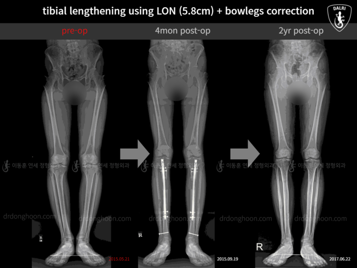 Tibial lengthening, 5.8 cm gained