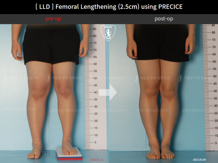 ยืดกระดูกต้นขา เพิ่มขึ้น 2.5 ซม.