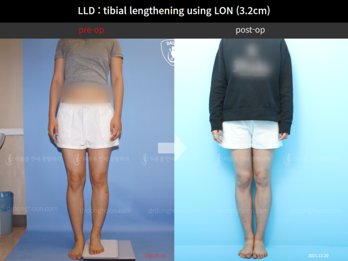 Tibial lengthening, 3.2 cm gained