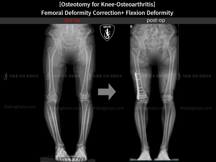 Femoral lengthening