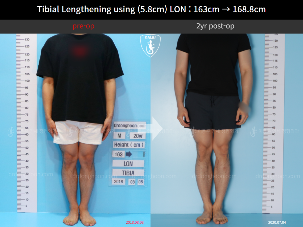 Tibial Lengthening Using (5.8cm) LON : 163cm → 168.8cm : 2yr Post-op ...