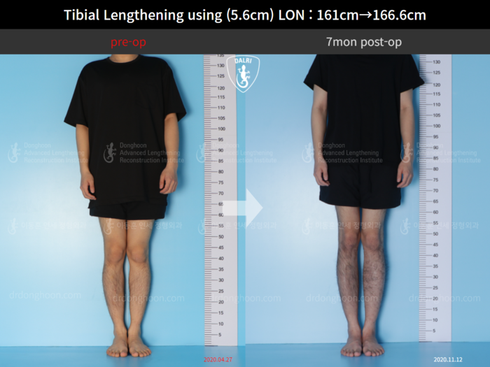 Tibial lengthening, 5.6 cm gained