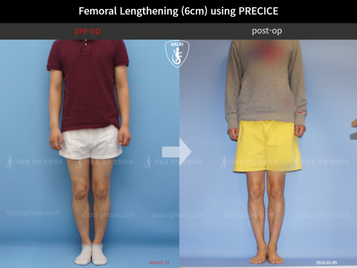 Femoral lengthening, 6 cm gained