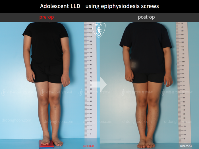 Paediatric & adolescent LLD