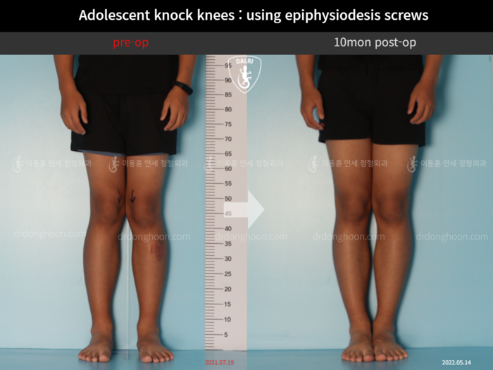 Paediatric & adolescent knock knees