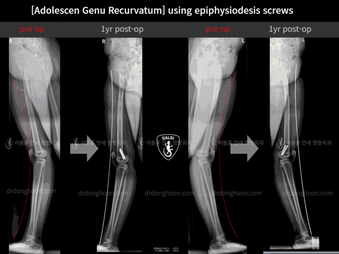 Paediatric & adolescent knock knees