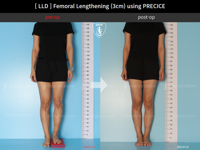 Femoral lengthening, 3 cm gained