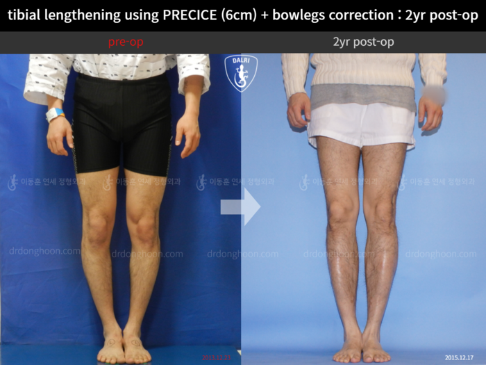 Tibial lengthening, 6 cm gained