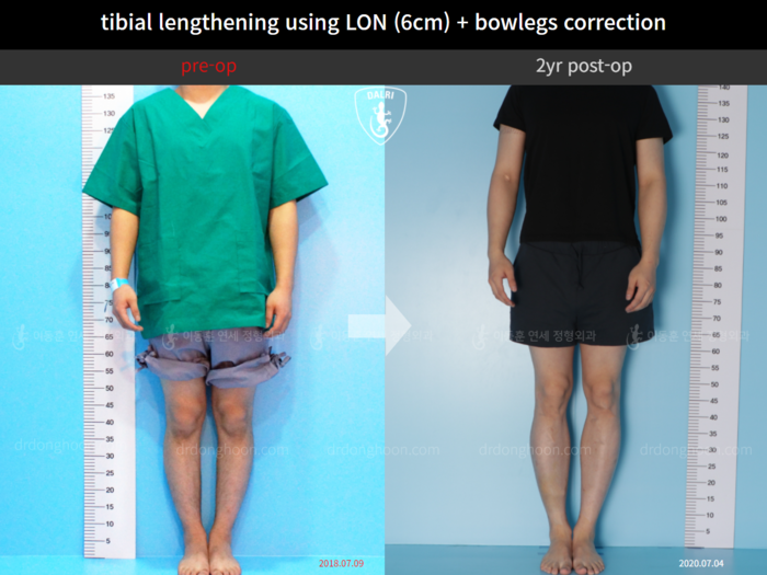 Tibial lengthening, 6 cm gained