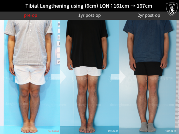 Tibial lengthening, 6 cm gained