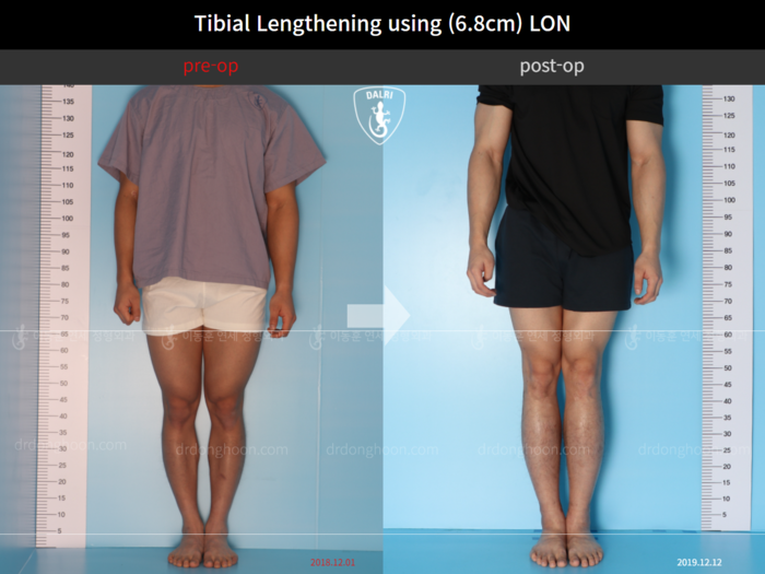 Tibial lengthening, 6.8 cm gained