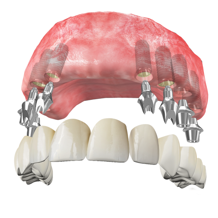 전체 임플란트