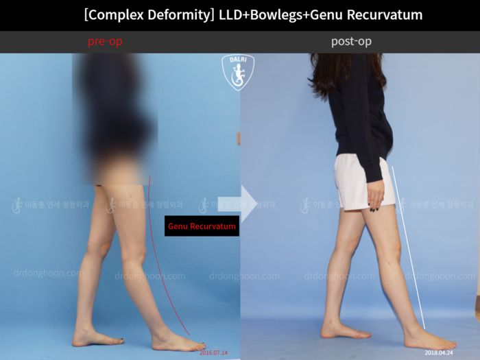 Genu recurvatum