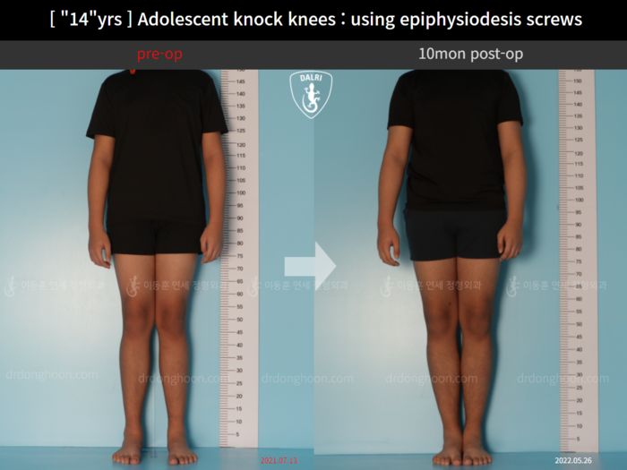 Paediatric & adolescent knock knees