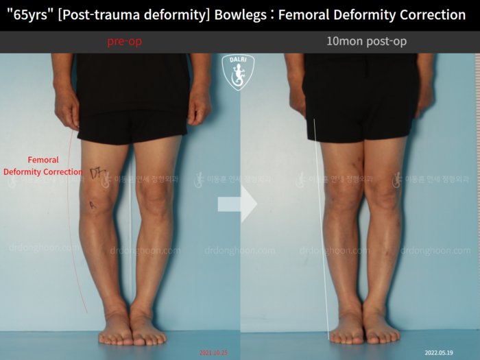 Femoral lengthening