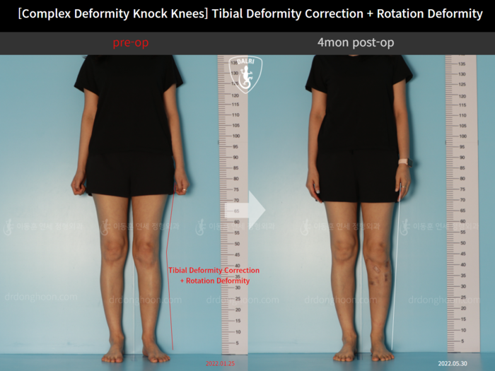 Tibial lengthening
