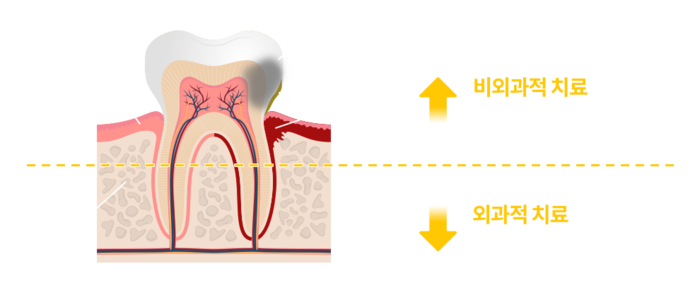 수성아이비치과 | 치주수술