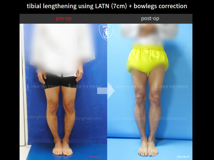 Tibial lengthening, 7 cm gained