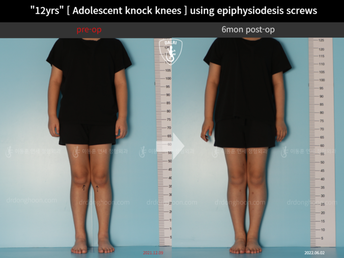 Paediatric & adolescent knock knees