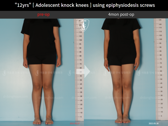 Paediatric & adolescent knock knees