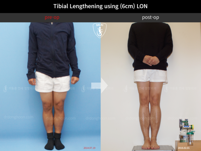 Tibial lengthening, 6 cm gained