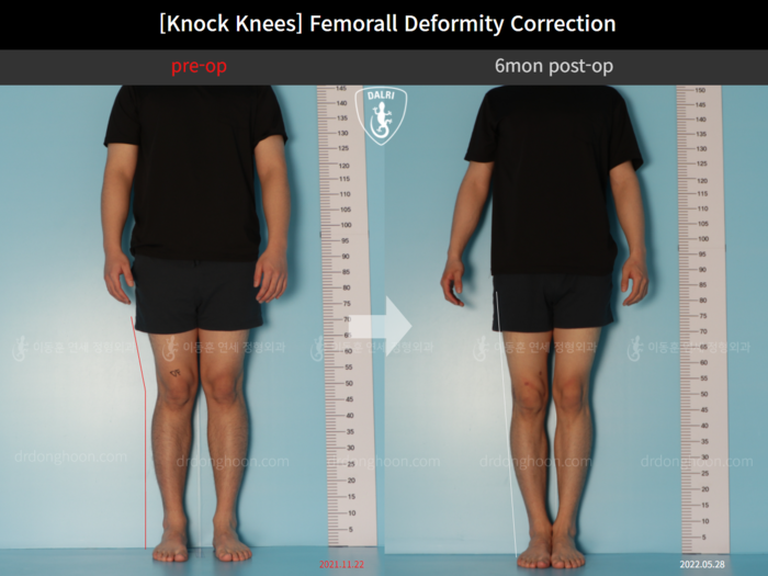 Femoral lengthening
