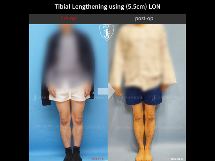 Tibial lengthening, 5.5 cm gained