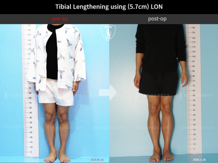 Tibial lengthening, 5.7 cm gained