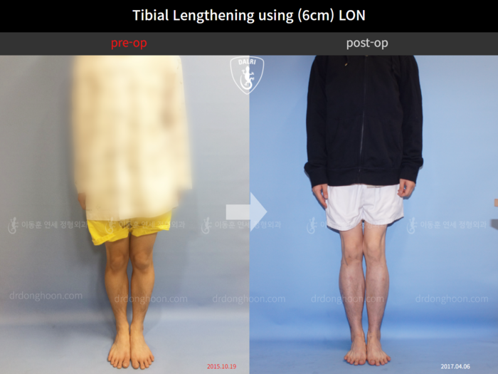 Tibial Lengthening (6cm) using LON