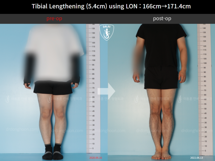 Tibial lengthening, 5.4 cm gained