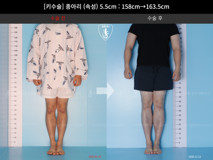Tibial lengthening, 5.5 cm gained